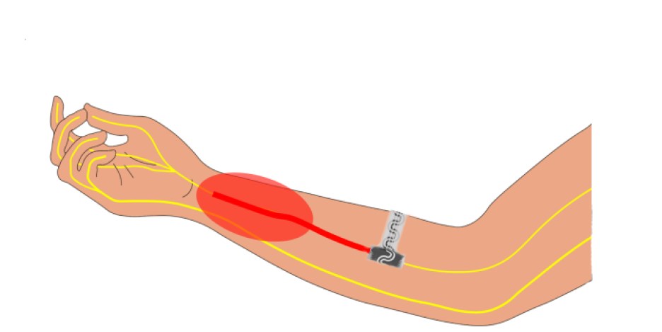 Illustration of Northwestern University’s implantable device for pain relief inside an arm. 