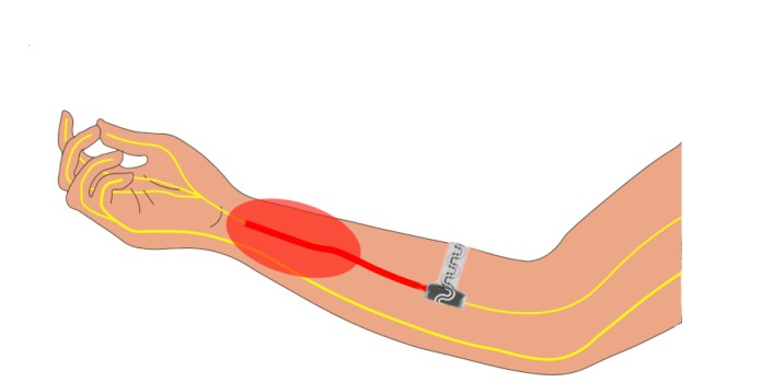 Illustration of Northwestern University’s implantable device for pain relief inside an arm.