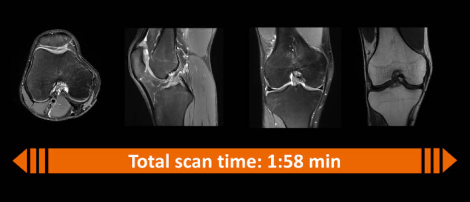 Deep Resolve reduces an MRI scan of a knee from about 10 minutes to less than two minutes.