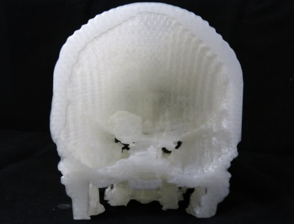 3D Printer Brain Tumor B