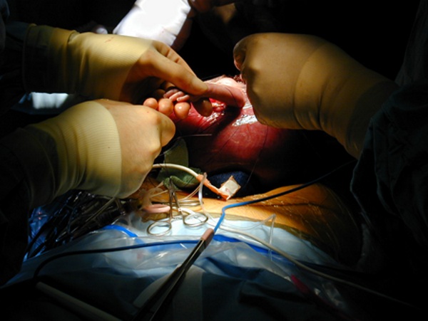 Fetal operation