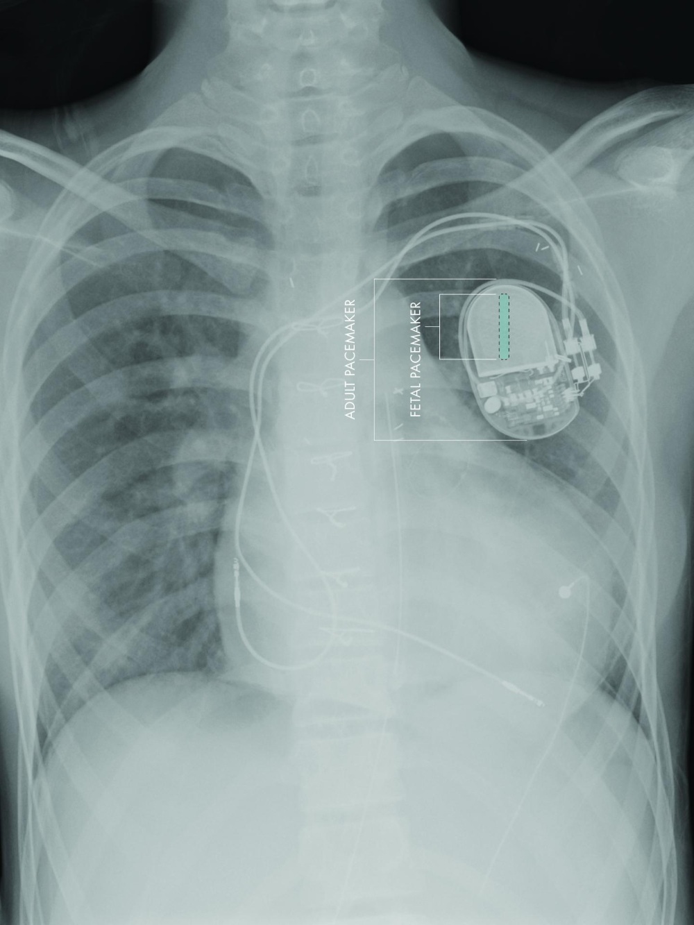 Micropacemaker