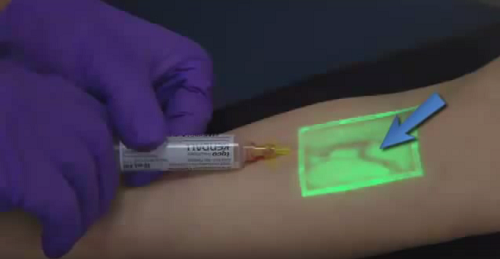 VeinViewer projected on arm