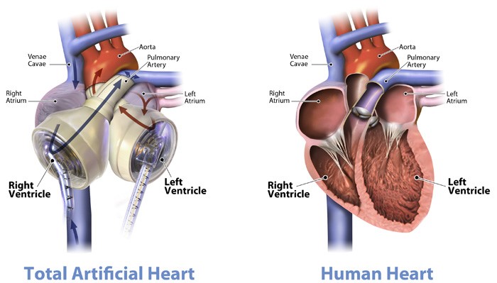 Syncardia_2