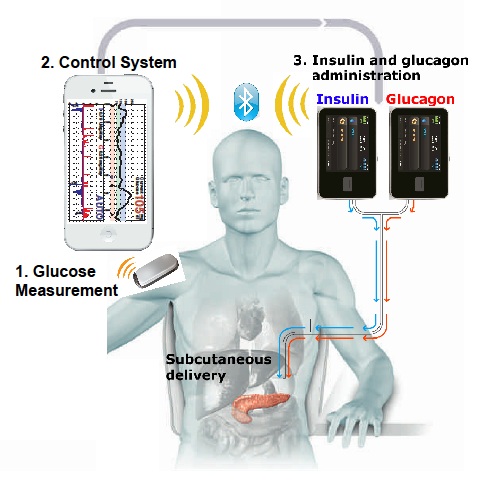 Bionic Pancreas 02