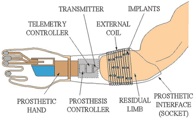 Advancing prosthetic limb technology with robotics
