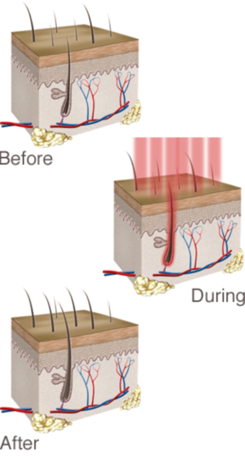 How low level light therapy works on hair