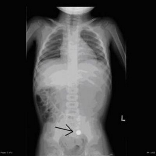 six year old that swallowed battery