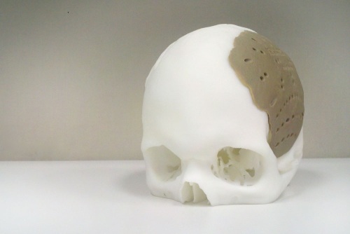 Skull prosthetic produced using 3D printer