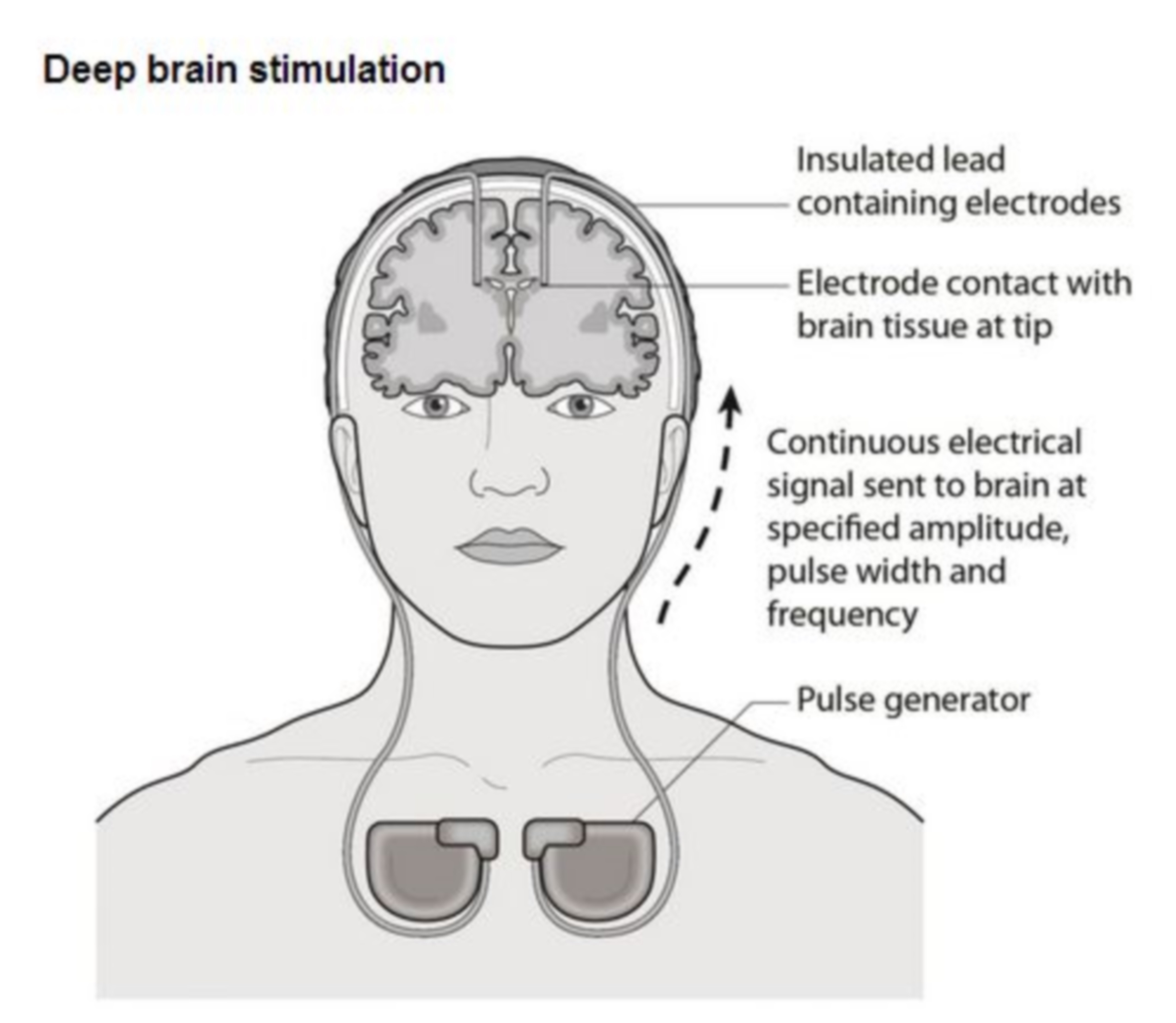 Deep Brain Stimulation