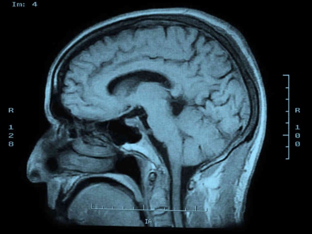 MRI of head